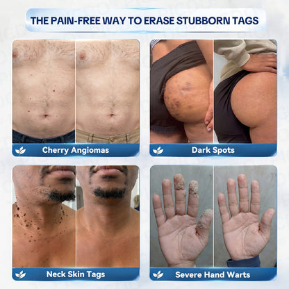 𝐏𝐢𝐜𝐝𝐨® 🌿7-𝐃𝐚𝐲 𝐒𝐤𝐢𝐧 𝐓𝐚𝐠 & 𝐒𝐩𝐨𝐭 𝐄𝐫𝐚𝐬𝐞𝐫 𝐂𝐫𝐞𝐚𝐦(Zero Pain, Zero 𝐒𝐜𝐚𝐫𝐬 Formula)🌺