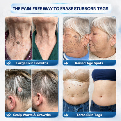 𝐏𝐢𝐜𝐝𝐨® 🌿7-𝐃𝐚𝐲 𝐒𝐤𝐢𝐧 𝐓𝐚𝐠 & 𝐒𝐩𝐨𝐭 𝐄𝐫𝐚𝐬𝐞𝐫 𝐂𝐫𝐞𝐚𝐦(Zero Pain, Zero 𝐒𝐜𝐚𝐫𝐬 Formula)🌺