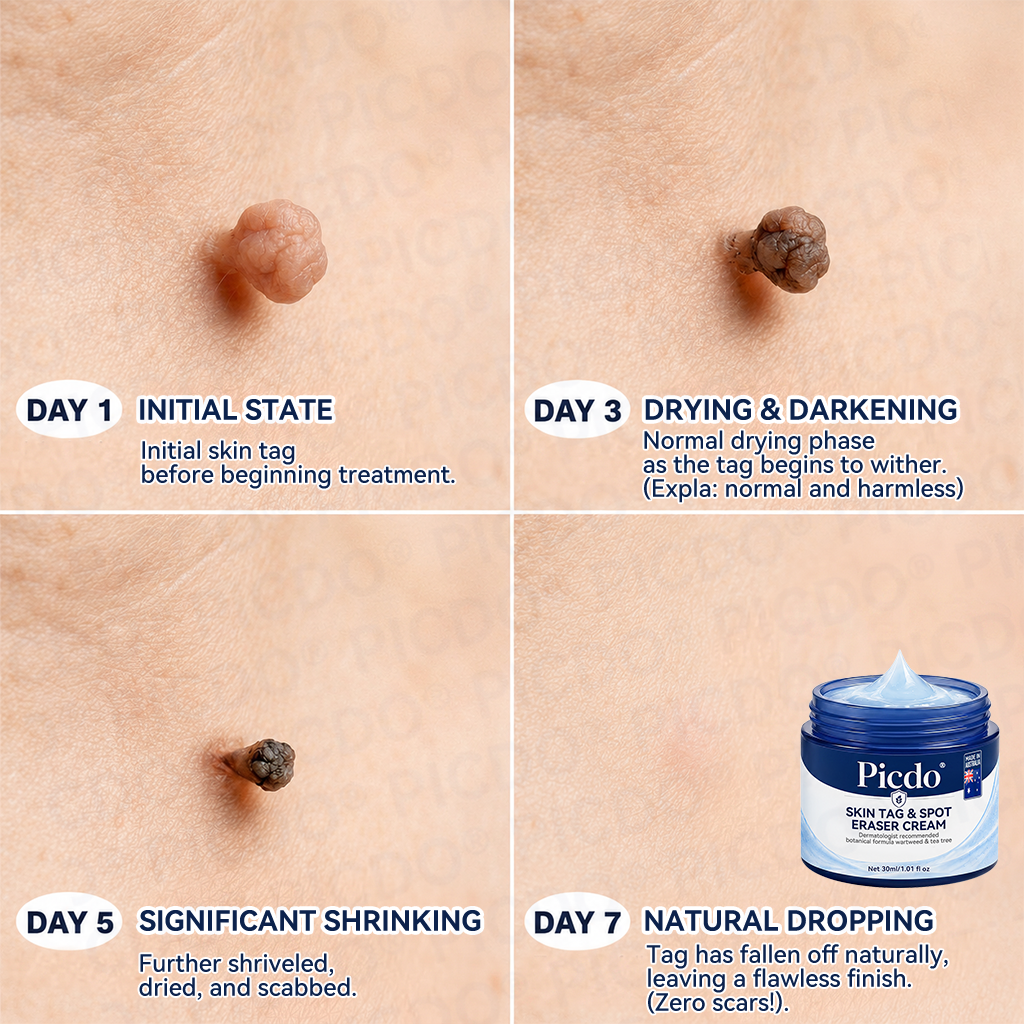 𝐏𝐢𝐜𝐝𝐨® 🌿7-𝐃𝐚𝐲 𝐒𝐤𝐢𝐧 𝐓𝐚𝐠 & 𝐒𝐩𝐨𝐭 𝐄𝐫𝐚𝐬𝐞𝐫 𝐂𝐫𝐞𝐚𝐦(Zero Pain, Zero 𝐒𝐜𝐚𝐫𝐬 Formula)🌺
