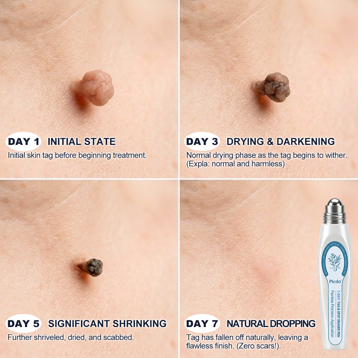 Official Store🌵𝐏i𝐜𝐝o® 7-𝐷𝑎𝑦 𝗧𝐚𝐠 & 𝗦𝗽𝐨𝐭 𝐄𝐫𝒂𝒔𝒆𝒓(Zero Pain, Zero 𝐒𝐜𝐚𝒓𝒔 Rollerball)